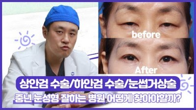 중년 눈성형 상안검수술 하안검수술 눈썹거상술 잘하는 병원 찾는 방법